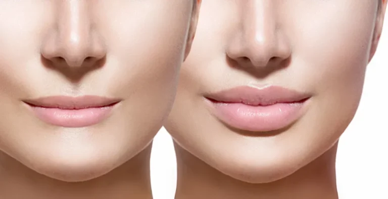 Before and After Lip Fillers 1536x790 1 1024x527 1 768x395