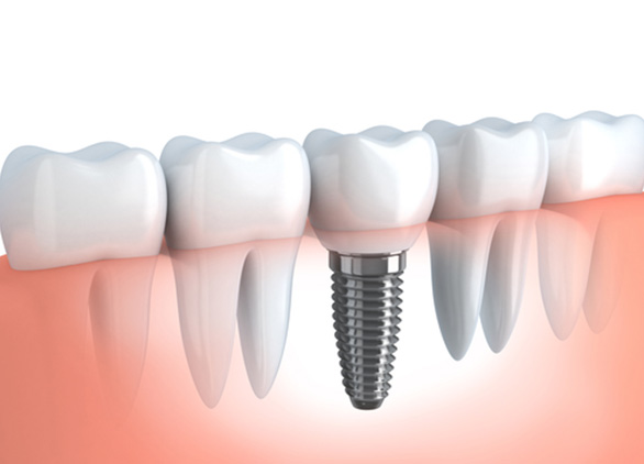 dental implants slider2