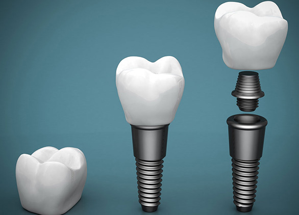 dental implants slider31
