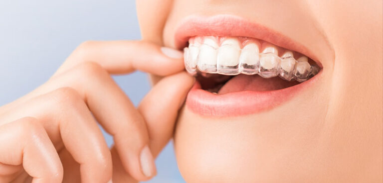 invisalign slide1 768x368