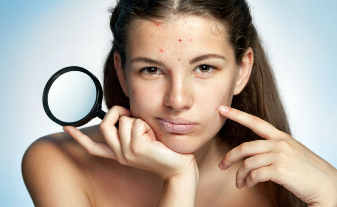 Some Ideas for Prescribing Homeopathics for Rashes: Acne