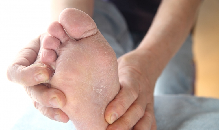Essential Oil Remedies for Athlete’s Foot