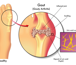 Gout May Increase Risk of Advanced Kidney Disease