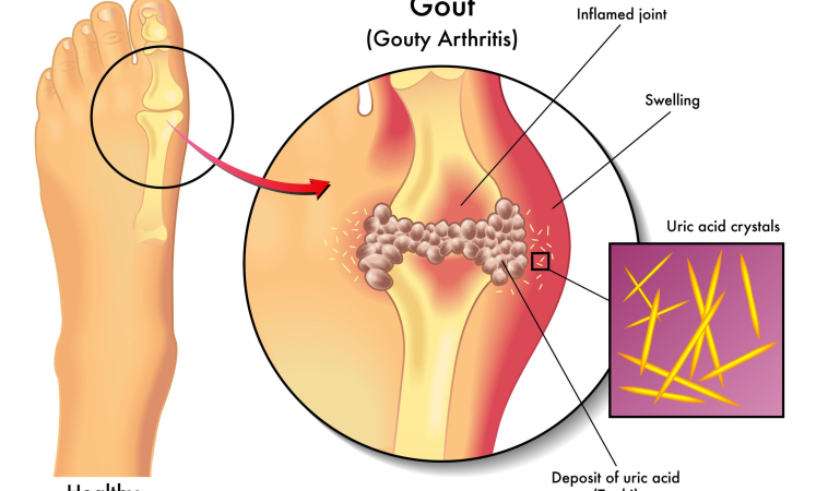 Gout May Increase Risk of Advanced Kidney Disease