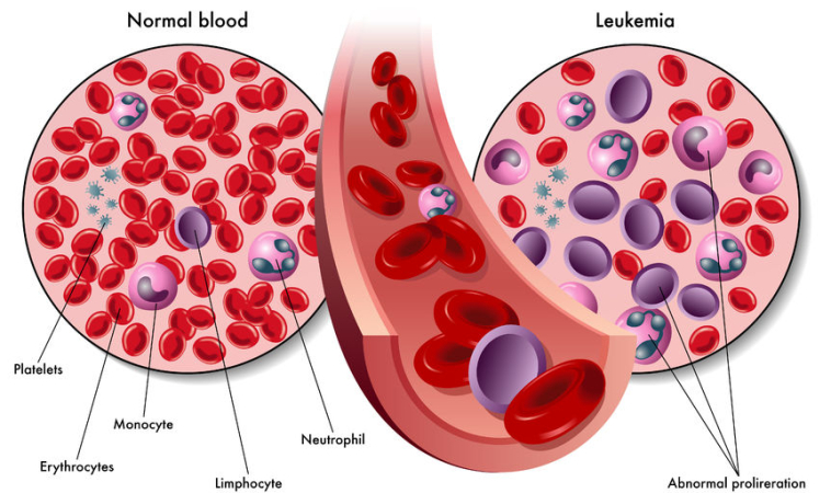 Tracking Cancer Through Blood Biopsy