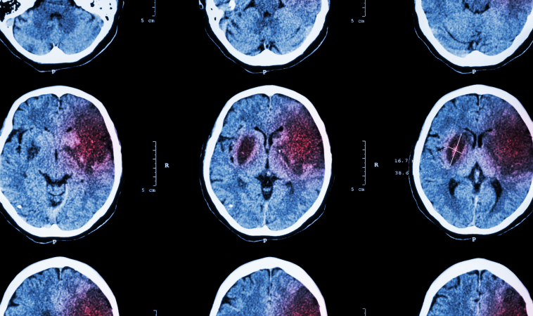 Using MRI to Find a Common Cognitive Disorder