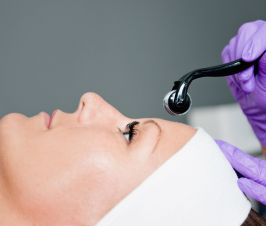 Microneedling for Reducing Acne Scars