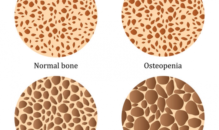 Osteoporosis Strongly Associated with Heart Disease in Women