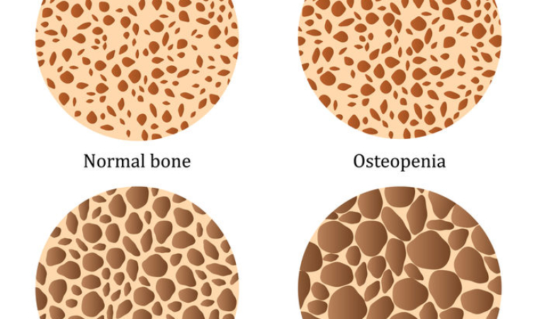 Osteoporosis Strongly Associated with Heart Disease in Women