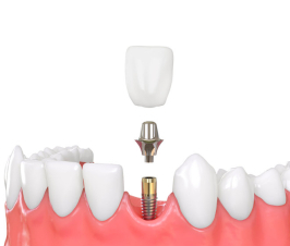 What Would a ‘Smart Dental Implant’ Look Like?