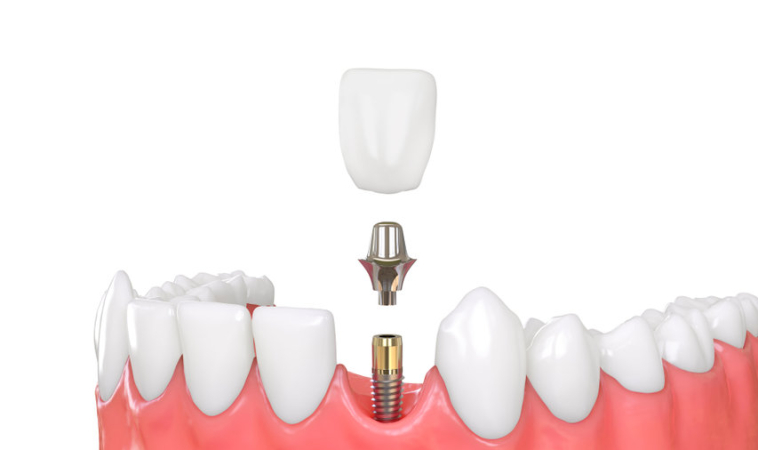 What Would a ‘Smart Dental Implant’ Look Like?