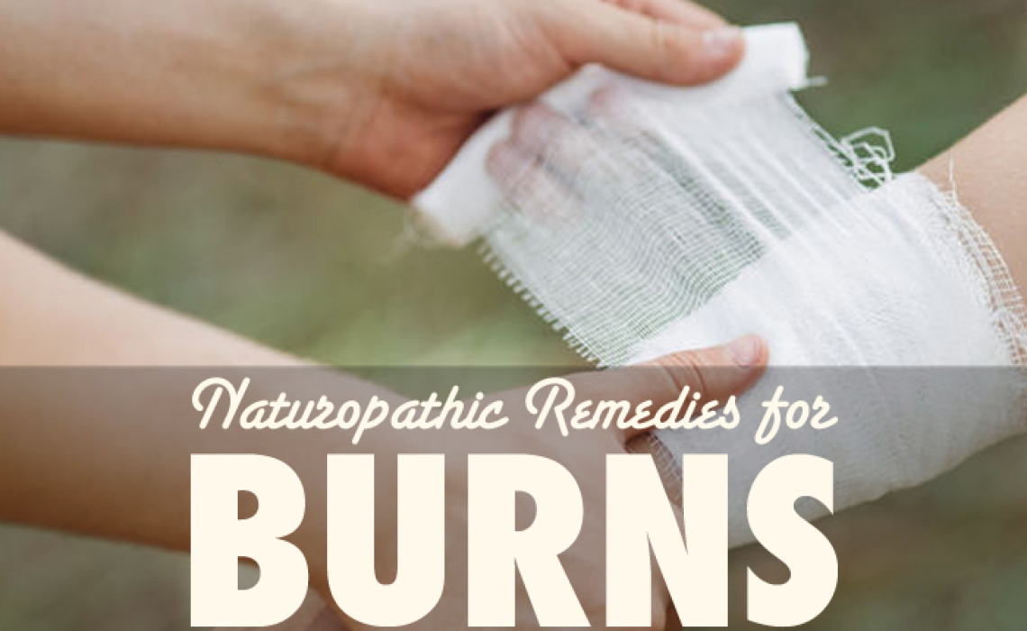 Naturopathic Remedies for Burns