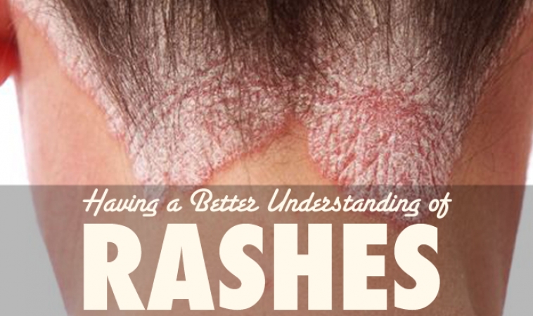 A Rash, is not a Rash, is not a Rash: Part 1