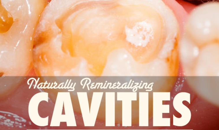 Remineralizing Cavities Naturally