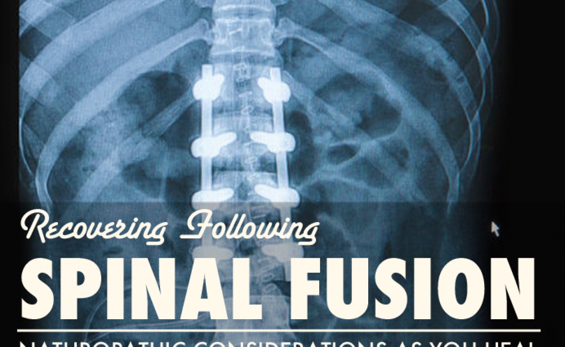 Recovering After Spinal Fusion